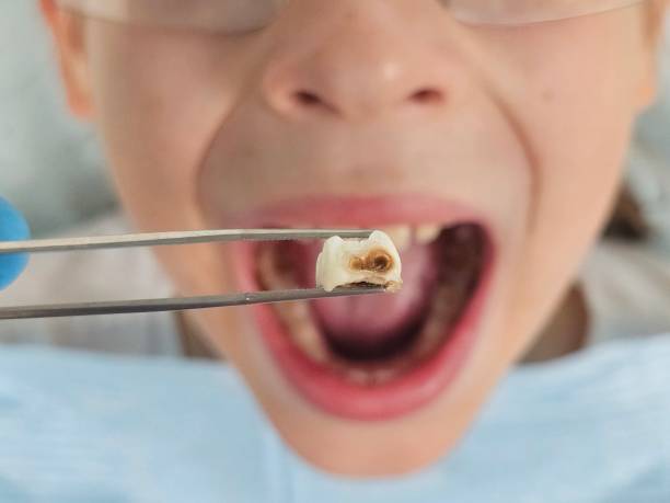 Best Cracked Tooth Emergency Dentist  in Green, OH